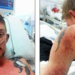 Синдром Стивенса-Джонсона: причины, симптомы, лечение