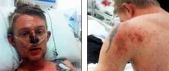 Stevens-Johnson syndrome: causes, symptoms, treatment