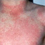 Scarlet fever in children: symptoms