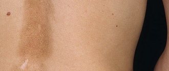 Scleroderma