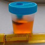 Mucus in urine analysis