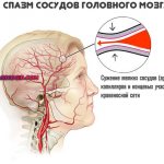 спазм сосудов головного мозга