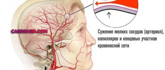 cerebral vasospasm