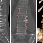 Spondyloarthrosis of the lumbar spine: an insidious disease leading to paralysis