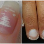 Moderate and severe form of leukonychia