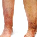 stages of gangrenous disease