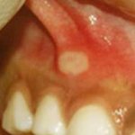 Стоматит на десне