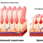 строение стенок здорового и больного кишечника