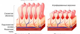 structure of the walls of healthy and diseased intestines