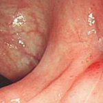 свищ прямой кишки