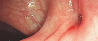 rectal fistula
