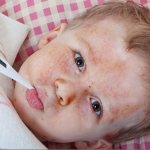 Rash and fever in a child, what kind of disease?