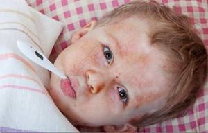 Сыпь и температура у ребенка что за болезнь