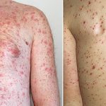 Scarlet fever rash