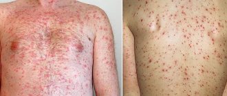Scarlet fever rash