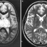 Thalamic syndrome: what it is, treatment, prognosis - tips and recommendations about health on AllMedNews.ru