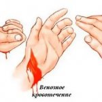 Technique for applying a tourniquet to the thigh