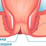 Anal fissures: causes and treatment, symptoms, effective remedies