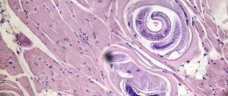 Trichinosis