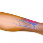 thrombophlebitis