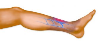 thrombophlebitis