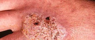 Lupus