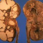 Tuberculosis of the genitourinary system (nephrotuberculosis)