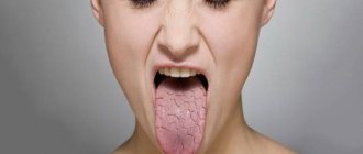 The girl has cracks in her tongue