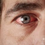 Uveitis is an inflammation of the posterior and anterior parts of the uvea of ​​the eye.