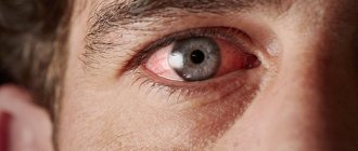 Увеит — воспаление заднего и переднего отделов сосудистой оболочки глаза