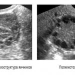 УЗ диагностика позволяет отличить мультифолликулярные яичники от более грозного заболевания - поликистоза