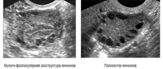 Ultrasound diagnostics makes it possible to distinguish multifollicular ovaries from a more serious disease - polycystic disease
