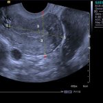 Ultrasound of the uterus on the 19th day of the cycle