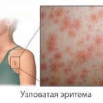 erythema nodosum