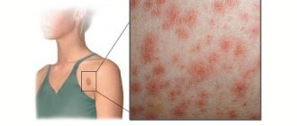 erythema nodosum