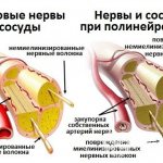 Diabetic neuropathy is caused by damage to the smallest blood vessels