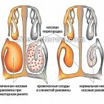 Vasotomy of the nasal turbinates for vasomotor rhinitis