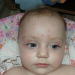 Chickenpox in children, photo of the initial stage