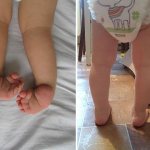 виды детского косолапия