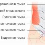 Types of abdominal hernia