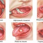 Виды стоматита