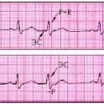extraordinary contraction of the heart