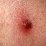 intradermal nevus