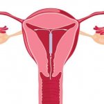 Intrauterine contraceptives: Intrauterine device