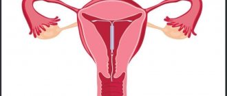 Внутриматочные контрацептивы: Внутриматочная спираль
