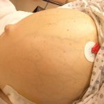 Hydrocele of the abdominal cavity in humans