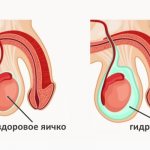 Водянка яичка у мужчины