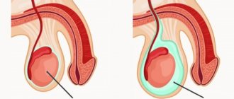 Dropsy of the testicles in a man