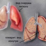 Inflammation of the pleura