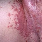 inflammation of the perineal area